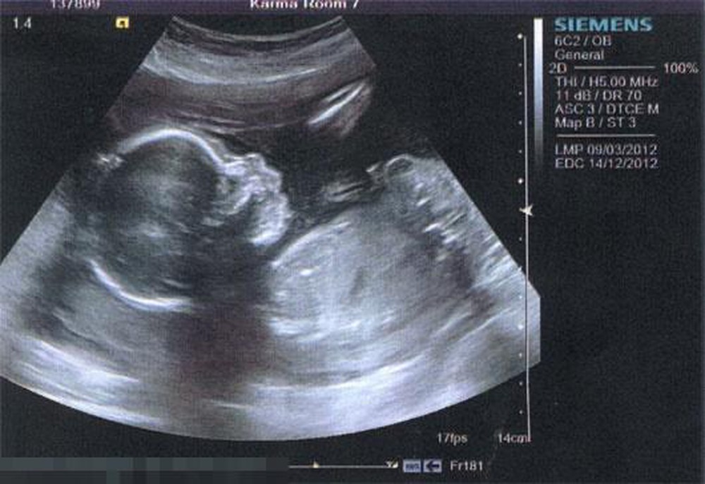 3 mốc siêu âm quan trọng khi mang thai 3 tháng đầu