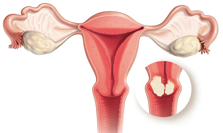 Ung thư cổ tử cung là một trong những bệnh thường gặp nhất ở phụ nữ