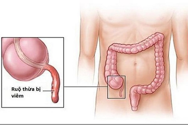đau bụng khi mang thai do viêm ruột thừa