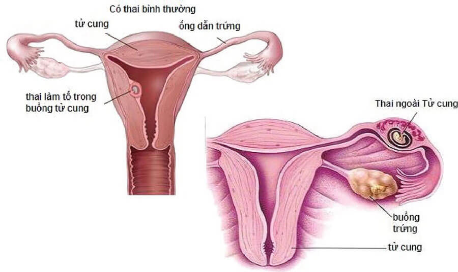 Hình ảnh mang thai bình thường và mang thai ngoài tử cung