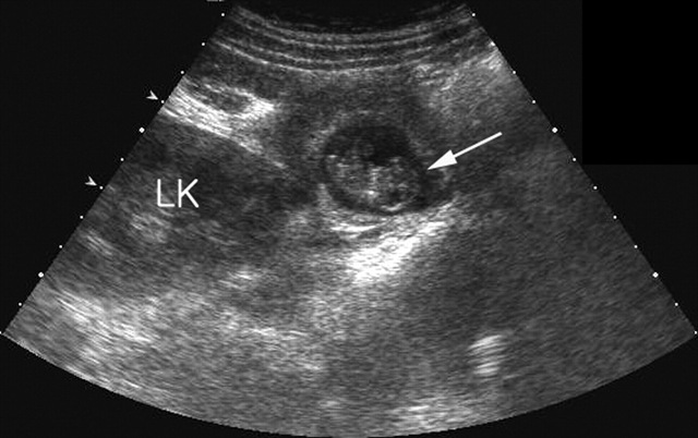 hình ảnh mang thai ngoài từ cung trên siêu âm