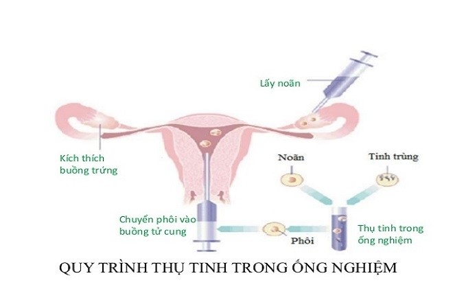 Quy trình cấy phôi thai được thực hiện trong 6 bước cơ bản