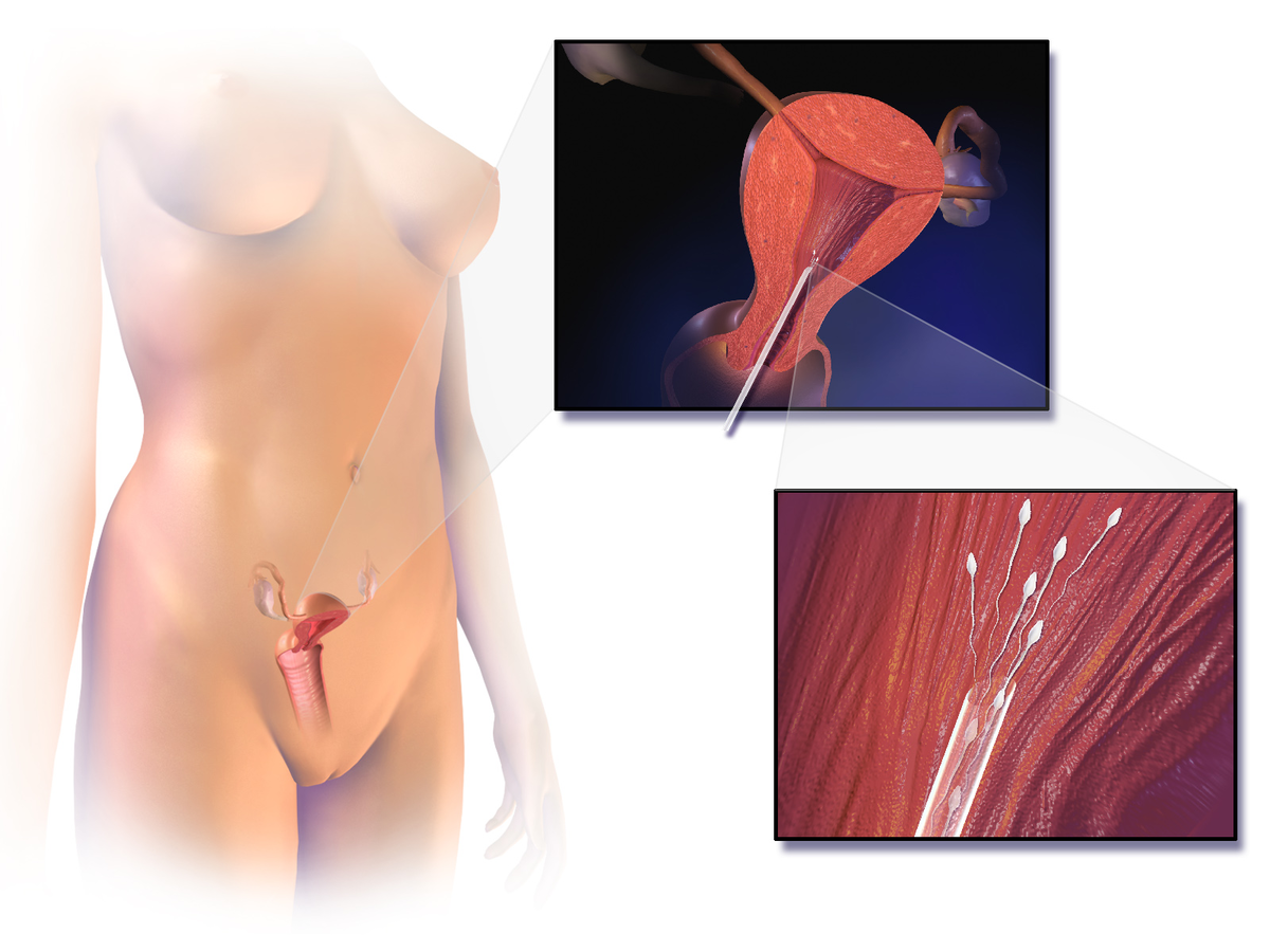 Thụ tinh nhân tạo là bơm tinh trùng vào tử cung phụ nữ